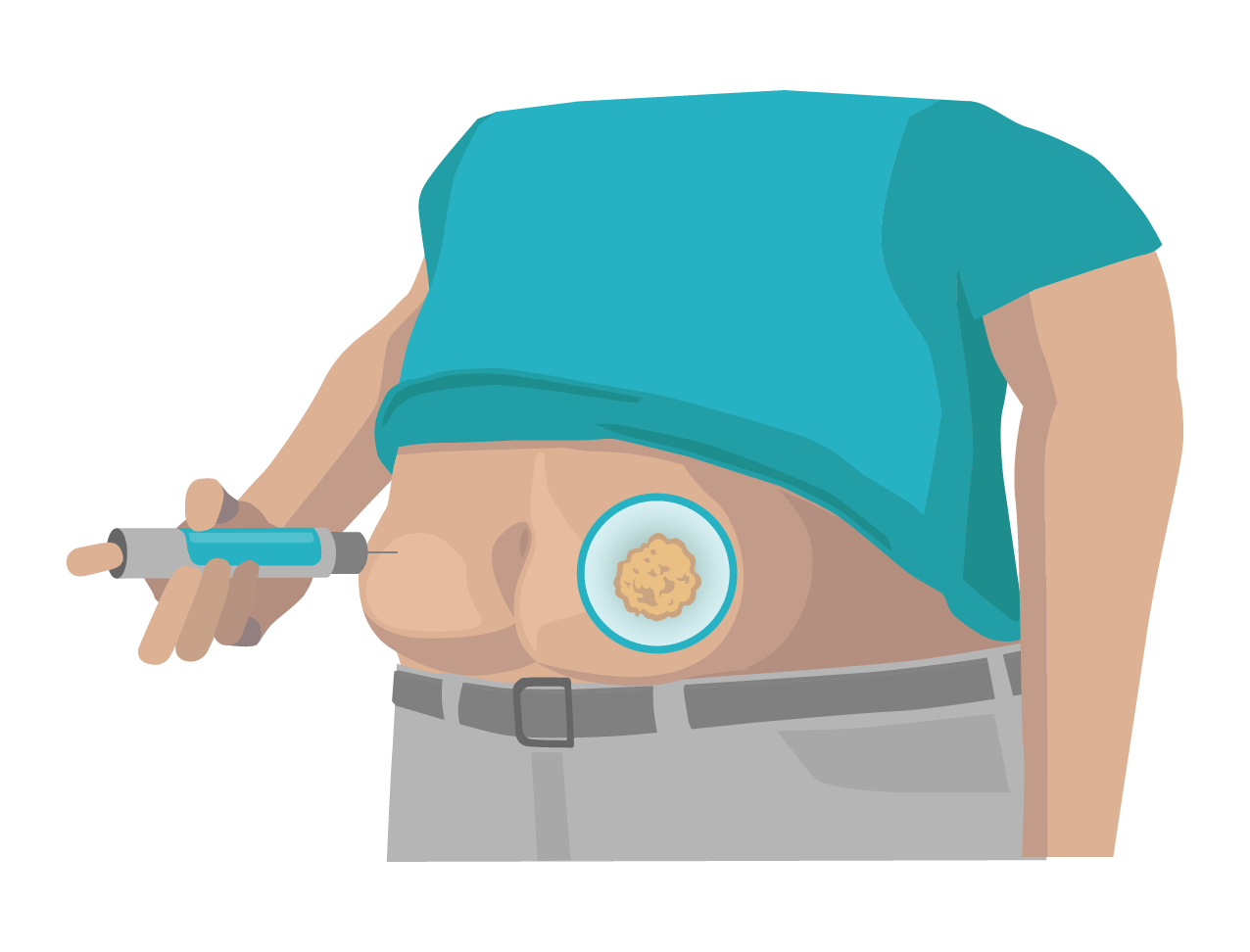 Injection on the abdomen